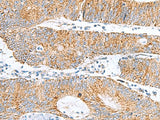 Immunohistochemistry of paraffin-embedded Human colorectal cancer tissue using GCSH Polyclonal Antibody at dilution of 1:60(×200)