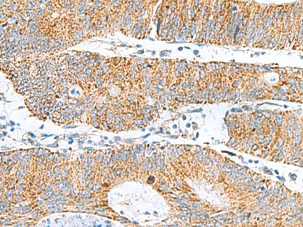 Immunohistochemistry of paraffin-embedded Human colorectal cancer tissue using GCSH Polyclonal Antibody at dilution of 1:60(×200)