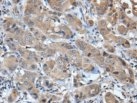 Immunohistochemistry of paraffin-embedded Human breast cancer tissue using CXCL5 Polyclonal Antibody at dilution of 1:45(×200)