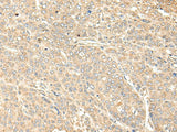 Immunohistochemistry of paraffin-embedded Human liver cancer tissue using WDFY4 Polyclonal Antibody at dilution of 1:50(×200)