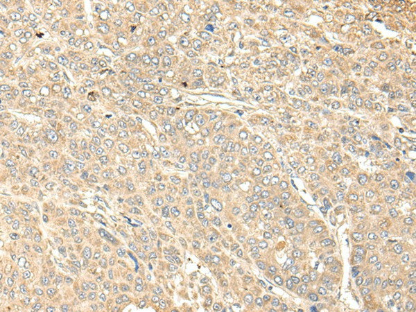 Immunohistochemistry of paraffin-embedded Human liver cancer tissue using WDFY4 Polyclonal Antibody at dilution of 1:50(×200)