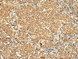 Immunohistochemistry of paraffin-embedded Human cervical cancer tissue using P2RY14 Polyclonal Antibody at dilution of 1:25(×200)