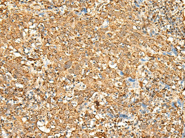 Immunohistochemistry of paraffin-embedded Human cervical cancer tissue using P2RY14 Polyclonal Antibody at dilution of 1:25(×200)