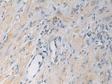 Immunohistochemistry of paraffin-embedded Human gastric cancer tissue using HSDL2 Polyclonal Antibody at dilution of 1:55(×200)