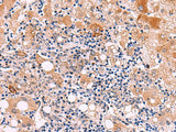 Immunohistochemistry of paraffin-embedded Human liver cancer tissue using KATNAL1 Polyclonal Antibody at dilution of 1:80(×200)