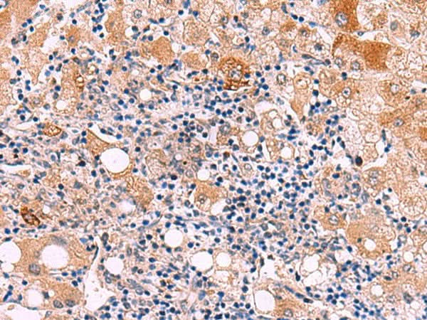 Immunohistochemistry of paraffin-embedded Human liver cancer tissue using KATNAL1 Polyclonal Antibody at dilution of 1:80(×200)