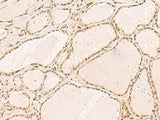 Immunohistochemistry of paraffin-embedded Human thyroid cancer tissue using RFX6 Polyclonal Antibody at dilution of 1:50(×200)