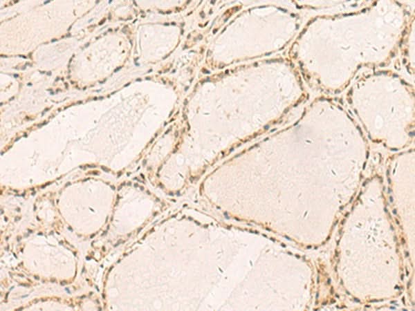Immunohistochemistry of paraffin-embedded Human thyroid cancer tissue using RFX6 Polyclonal Antibody at dilution of 1:50(×200)