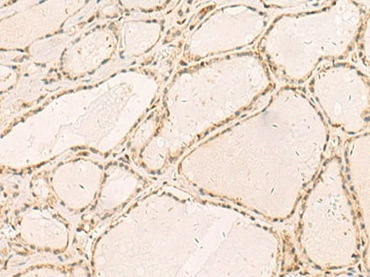 Immunohistochemistry of paraffin-embedded Human thyroid cancer tissue using RFX6 Polyclonal Antibody at dilution of 1:50(×200)