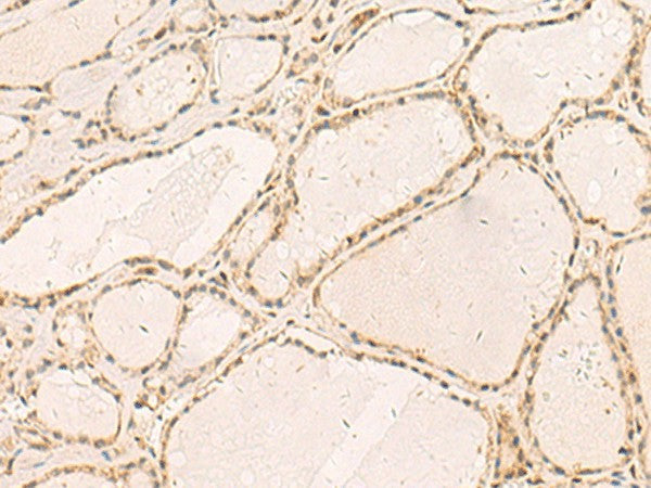 Immunohistochemistry of paraffin-embedded Human thyroid cancer tissue using RFX6 Polyclonal Antibody at dilution of 1:50(×200)