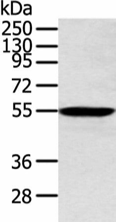 Western blot analysis of Human lung cancer tissue using ALDH2 Polyclonal Antibody at dilution of 1:300