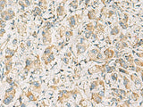 Immunohistochemistry of paraffin-embedded Human liver cancer tissue using PDE4DIP Polyclonal Antibody at dilution of 1:60(×200)