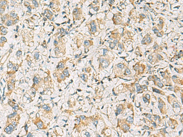 Immunohistochemistry of paraffin-embedded Human liver cancer tissue using PDE4DIP Polyclonal Antibody at dilution of 1:60(×200)