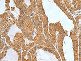 Immunohistochemistry of paraffin-embedded Human thyroid cancer tissue using ITGB1BP1 Polyclonal Antibody at dilution of 1:50(×200)
