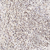 Immunohistochemistry analysis of paraffin-embedded human lung cancer using c-Fos Polyclonal Antibody at dilution of 1:200.