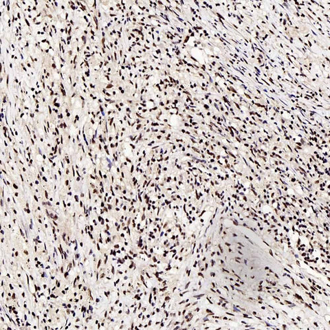 Immunohistochemistry analysis of paraffin-embedded human lung cancer using c-Fos Polyclonal Antibody at dilution of 1:200.