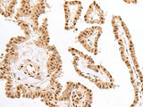 Immunohistochemistry of paraffin-embedded Human thyroid cancer tissue using KDM2A Polyclonal Antibody at dilution of 1:60(×200)