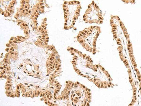 Immunohistochemistry of paraffin-embedded Human thyroid cancer tissue using KDM2A Polyclonal Antibody at dilution of 1:60(×200)