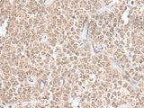 Immunohistochemistry of paraffin-embedded Human ovarian cancer tissue using THAP12 Polyclonal Antibody at dilution of 1:45(×200)