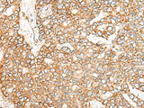 Immunohistochemistry of paraffin-embedded Human liver cancer tissue using NME4 Polyclonal Antibody at dilution of 1:45(×200)