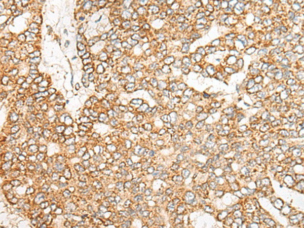 Immunohistochemistry of paraffin-embedded Human liver cancer tissue using NME4 Polyclonal Antibody at dilution of 1:45(×200)