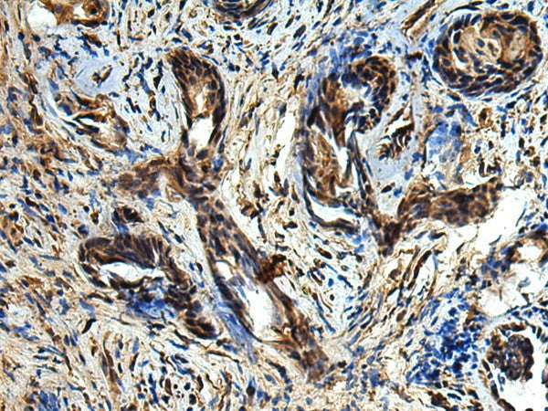 Immunohistochemistry of paraffin-embedded Human prost at e cancer tissue using TBCC Polyclonal Antibody at dilution of 1:80(×200)