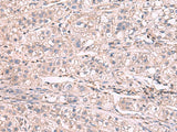 Immunohistochemistry of paraffin-embedded Human liver cancer tissue using KCNIP1 Polyclonal Antibody at dilution of 1:60(×200)