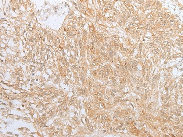 Immunohistochemistry of paraffin-embedded Human lung cancer tissue using ZNF34 Polyclonal Antibody at dilution of 1:40(×200)