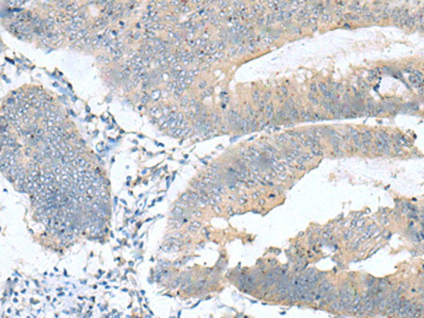 Immunohistochemistry of paraffin-embedded Human colorectal cancer tissue using KRCC1 Polyclonal Antibody at dilution of 1:60(×200)