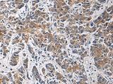 Immunohistochemistry of paraffin-embedded Human colorectal cancer tissue using TMOD3 Polyclonal Antibody at dilution of 1:60(×200)