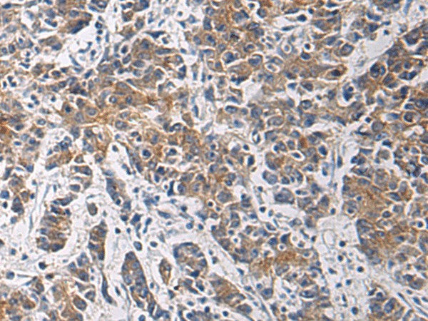 Immunohistochemistry of paraffin-embedded Human colorectal cancer tissue using TMOD3 Polyclonal Antibody at dilution of 1:60(×200)