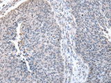 Immunohistochemistry of paraffin-embedded Human lung cancer tissue using ZNF23 Polyclonal Antibody at dilution of 1:50(×200)