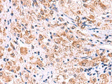 Immunohistochemistry of paraffin-embedded Human liver cancer tissue using ECSIT Polyclonal Antibody at dilution of 1:75(×200)