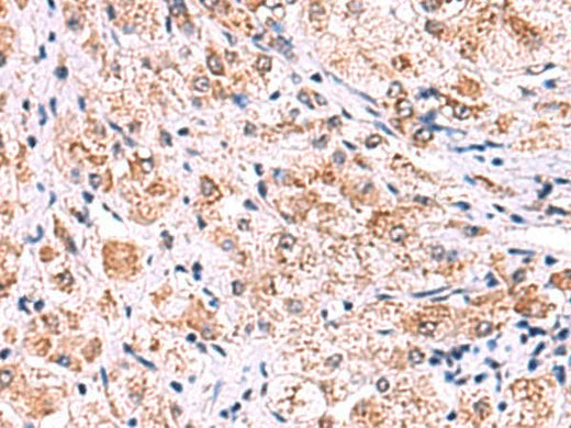 Immunohistochemistry of paraffin-embedded Human liver cancer tissue using ECSIT Polyclonal Antibody at dilution of 1:75(×200)