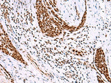 Immunohistochemistry of paraffin-embedded Human esophagus cancer tissue using ISY1-RAB43 Polyclonal Antibody at dilution of 1:30(×200)