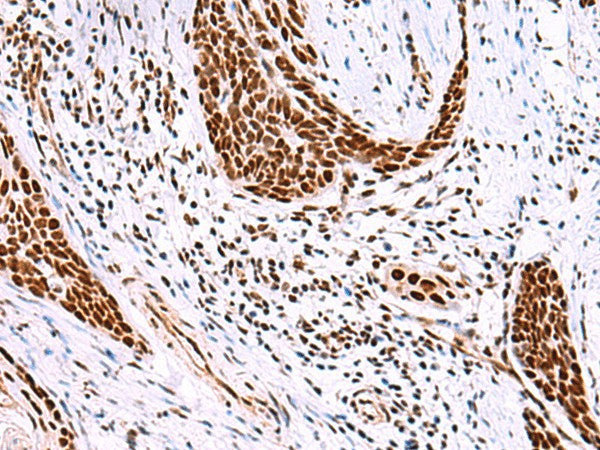 Immunohistochemistry of paraffin-embedded Human esophagus cancer tissue using ISY1-RAB43 Polyclonal Antibody at dilution of 1:30(×200)