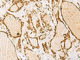 Immunohistochemistry of paraffin-embedded Human thyroid cancer tissue using NIPBL Polyclonal Antibody at dilution of 1:55(×200)