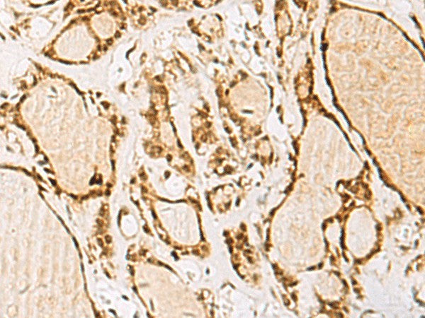 Immunohistochemistry of paraffin-embedded Human thyroid cancer tissue using NIPBL Polyclonal Antibody at dilution of 1:55(×200)