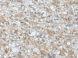 Immunohistochemistry of paraffin-embedded Human liver cancer tissue using KANSL1L Polyclonal Antibody at dilution of 1:55(×200)