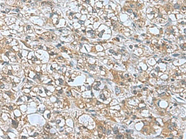 Immunohistochemistry of paraffin-embedded Human liver cancer tissue using KANSL1L Polyclonal Antibody at dilution of 1:55(×200)