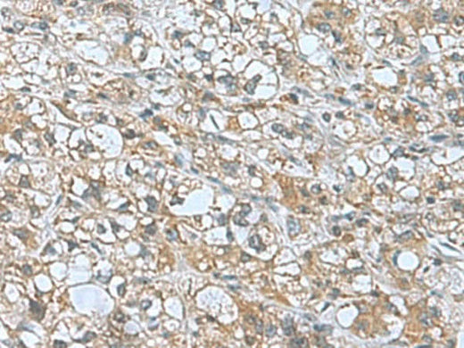 Immunohistochemistry of paraffin-embedded Human liver cancer tissue using KANSL1L Polyclonal Antibody at dilution of 1:55(×200)