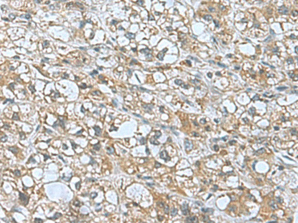 Immunohistochemistry of paraffin-embedded Human liver cancer tissue using KANSL1L Polyclonal Antibody at dilution of 1:55(×200)