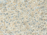 Immunohistochemistry of paraffin-embedded Human liver cancer tissue using KLC2 Polyclonal Antibody at dilution of 1:100(×200)