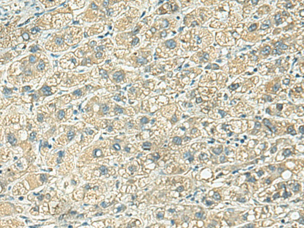 Immunohistochemistry of paraffin-embedded Human liver cancer tissue using KLC2 Polyclonal Antibody at dilution of 1:100(×200)