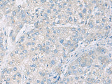 Immunohistochemistry of paraffin-embedded Human liver cancer tissue using DACT3 Polyclonal Antibody at dilution of 1:55(×200)