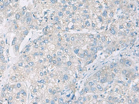Immunohistochemistry of paraffin-embedded Human liver cancer tissue using DACT3 Polyclonal Antibody at dilution of 1:55(×200)
