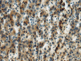 Immunohistochemistry of paraffin-embedded Human liver cancer tissue using MICA Polyclonal Antibody at dilution of 1:60(×200)