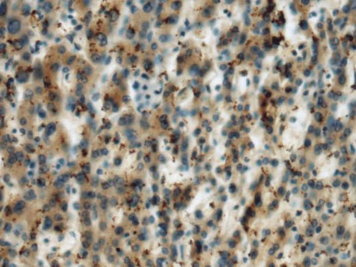 Immunohistochemistry of paraffin-embedded Human liver cancer tissue using MICA Polyclonal Antibody at dilution of 1:60(×200)