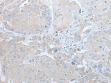 Immunohistochemistry of paraffin-embedded Human esophagus cancer tissue using IFNB1 Polyclonal Antibody at dilution of 1:45(×200)
