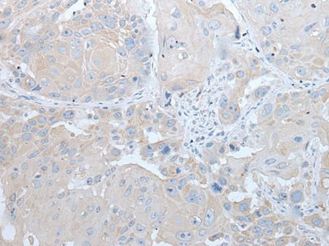 Immunohistochemistry of paraffin-embedded Human esophagus cancer tissue using IFNB1 Polyclonal Antibody at dilution of 1:45(×200)